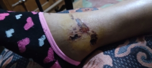 Otra mujer víctima de los motoladrones en Yopal
