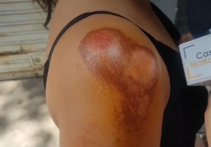 Madre e hija lesionadas en nuevo caso de raponazo en Yopal